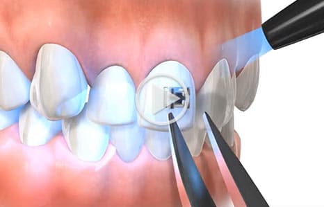 Bonding video at Southern Maine Orthodontics in Scarborough, ME