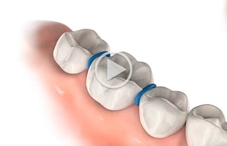 Tooth seperator at Southern Maine Orthodontics in Scarborough, ME