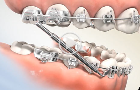 Appliance video at Southern Maine Orthodontics in Scarborough, ME