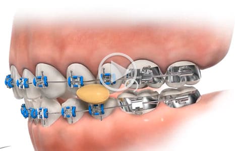 Foods to avoid at Southern Maine Orthodontics in Scarborough, ME