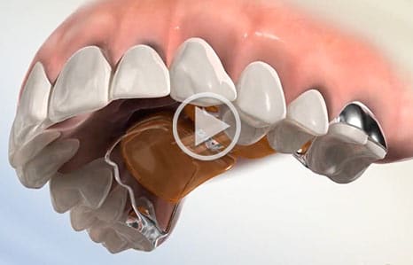 Expander video at Southern Maine Orthodontics in Scarborough, ME