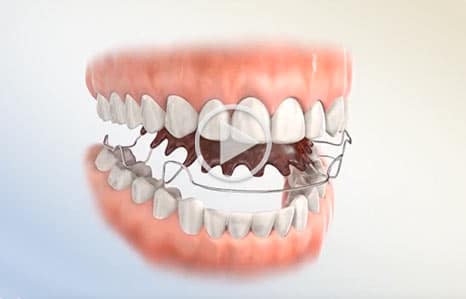 Retainer video at Southern Maine Orthodontics in Scarborough, ME
