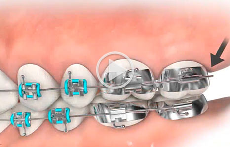 Video about poking wire at Southern Maine Orthodontics in Scarborough, ME