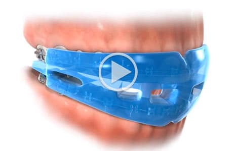 Video mouthguard at Southern Maine Orthodontics in Scarborough, ME